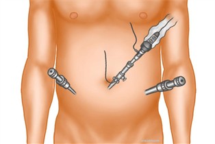 Laparaskopische Hernienversorgung - ©webop