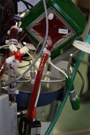 High-Flow ECMO, Kliniken Köln