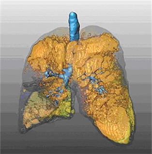 Abb.3: Computertomographie des Thorax