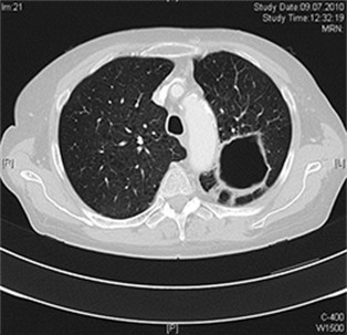 Computertomographie (CT) der Lunge