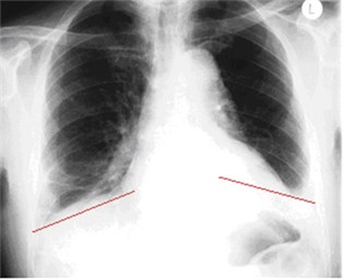 Abb.8 Röntgenbild des Brustkorbes bei Zwerchfelllähmung nach erfolgreicher operativer Zwerchfellraffung