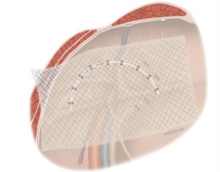 Laparaskopische Hernienversorgung mit Netz AnlageTAPP - ©webop