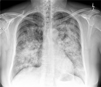 Granulomatose mit Polyangiitis Granulomatose mit Polyangiitis
