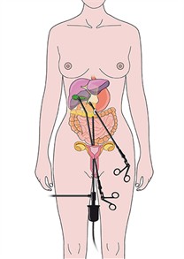 Grafik: ©  Vera Zimperfeld - Media Mädel - für  Kliniken der Stadt Köln 