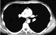 Mediastinum (CT- Thorax)