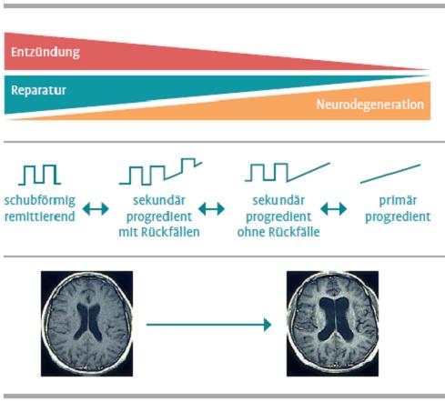 Abb.1. Klinische Formen und pathophysiologische Mechanismen der Multiplen Sklerose 