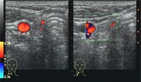 Hier sieht man im Ultraschallbild rechts neben der rot dargestellten Halsschlagader den kleinen verbliebenen Schilddrüsenrest., © Kliniken Köln