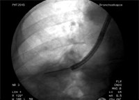 Transbronchiale Zangenbiopsien sowie Kryobiopsien, © Kliniken Köln