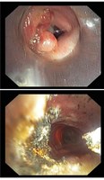 Abtragung von Granulations-gewebe im Bereich der Trachealkanüle mittels Lasertherapie, © Kliniken Köln