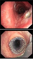 Stenteinlage in die proximale Trachea bei ösophagotrachealer Fistel, © Kliniken Köln