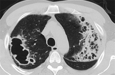 atypische Mykobacteriose durch Mykobacterium avium,  Foto:©Kliniken Köln/ Radiologie