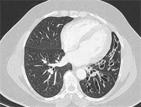 Bronchiektasen, Foto © Kliniken Köln