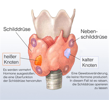 Schilddrüsenknoten; © Henrie Fotolia