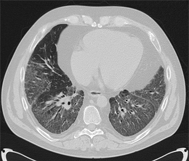 interstitielle Lungenerkrankung, Foto:©Kliniken Köln/ Berger