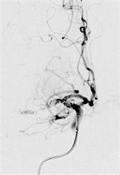 B Stentretriever durch Blutgerinnsel, ©Kliniken der Stadt Köln B Stentretriever durch Blutgerinnsel, ©Kliniken der Stadt Köln