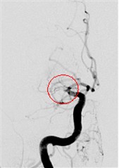 Verschluß der mittleren Gehirnarterie rechts, ©Kliniken der Stadt Köln Verschluß der mittleren Gehirnarterie rechts, ©Kliniken der Stadt Köln
