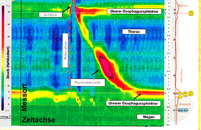 Grafische Darstellung der Ösophagusmanometrie. Bild: Kliniken der Stadt Köln
