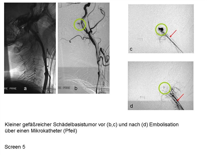 Das Bild zeigt einen kleinen gefäßreichen Schädelbasistumor von (b, c) und nach (d) Embolisation über einen Mikrokatheter