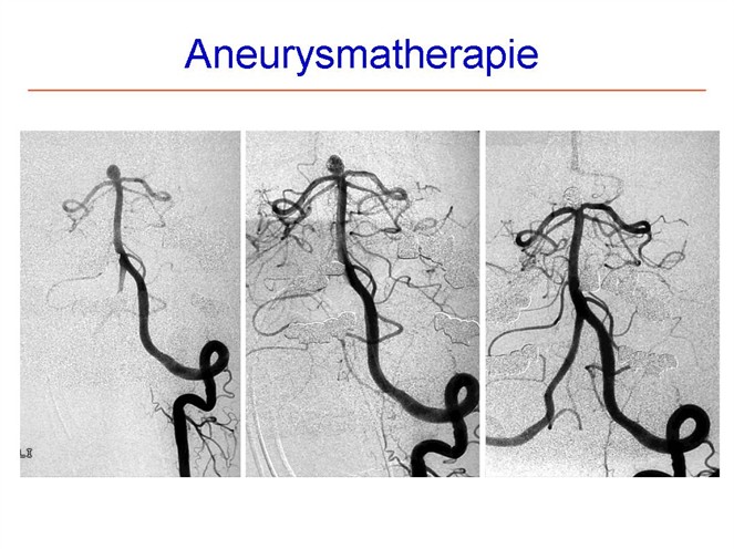 Auf dem linken Bild ist oben das Aneurysma noch gut zu erkennen, rechts nach der Behandlung nur noch zu erahnen.